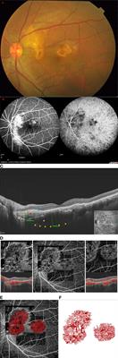 Appearance of Tumor Vessels in Patients With Choroidal Osteoma Using Swept-Source Optical Coherence Tomographic Angiography